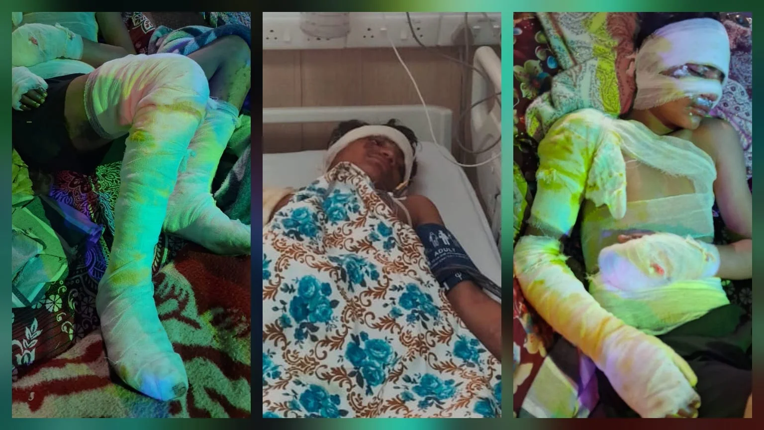 भगवानपुर में खौफनाक वारदात: केमिकल से भरे ड्रम साफ करते समय दो किशोर बुरी तरह झुलसे, फैक्ट्री में कराया जा रहा था बाल श्रम